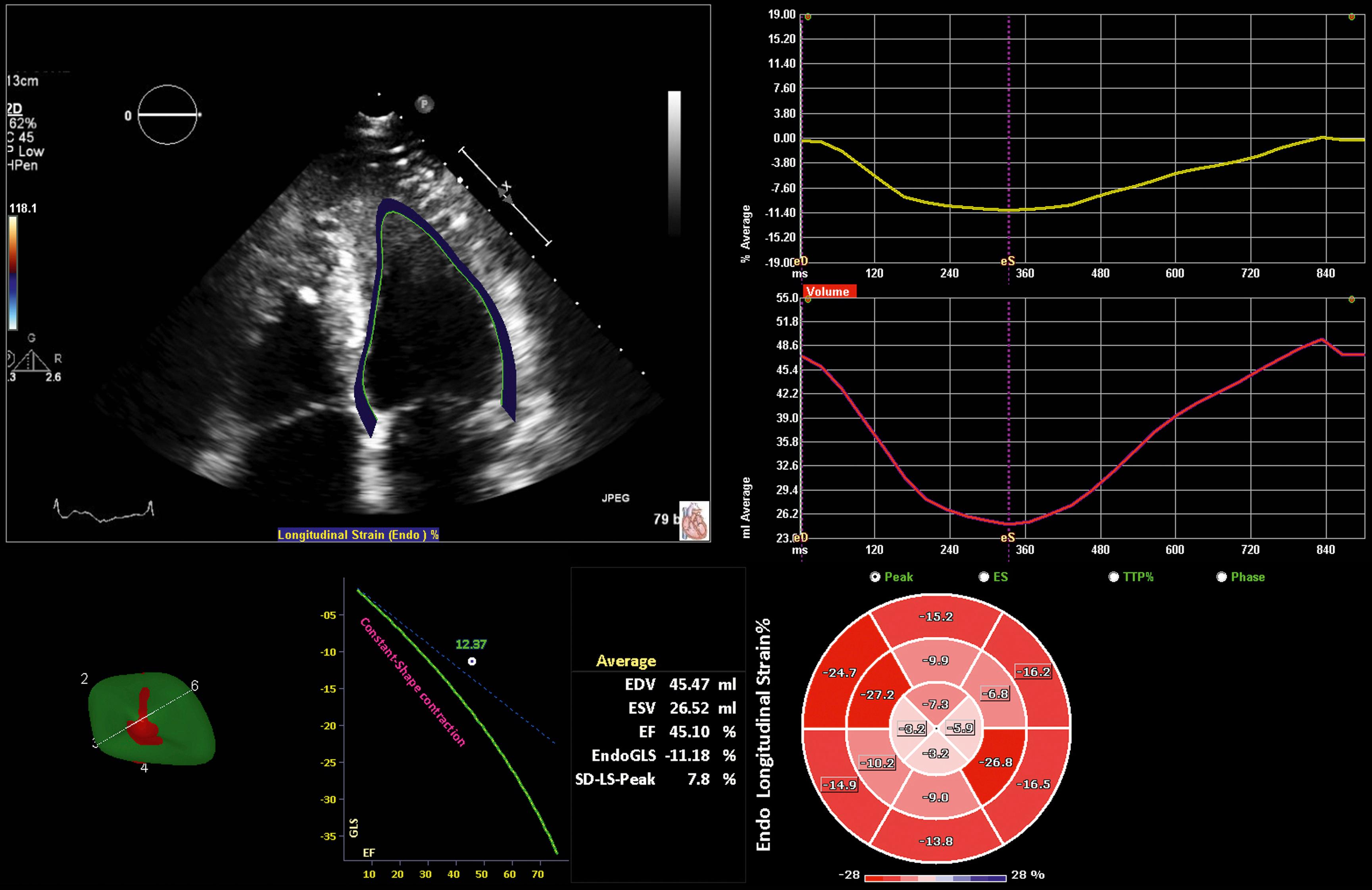 Figure 63.5, Speckle-tracking echocardiographic strain imaging from a 61-year-old woman with apical hypertrophic cardiomyopathy (A) . Bull’s eye plot (lower right) illustrates decreased global longitudinal strain of −11% with the major region of decreased strain at the apex.