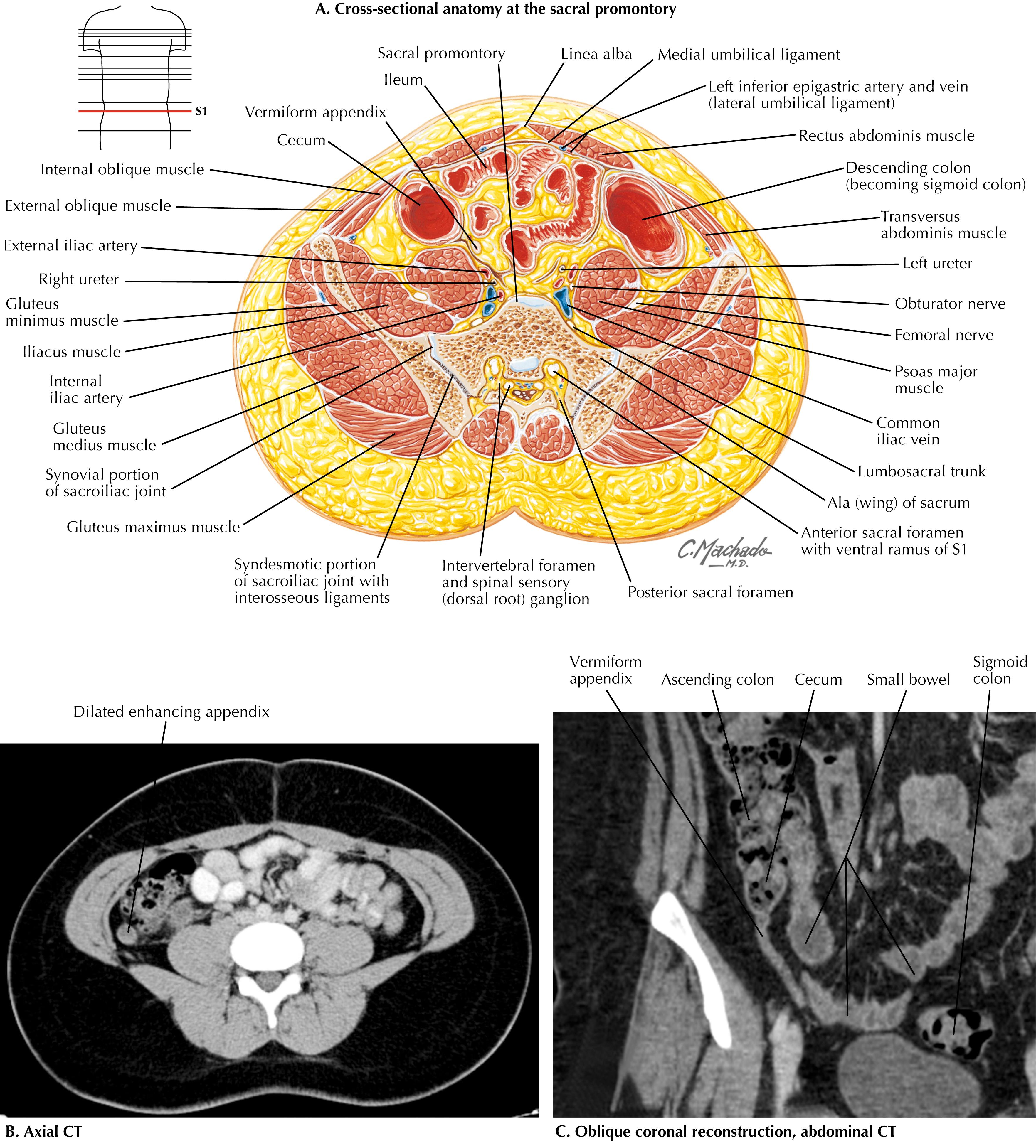 FIGURE 25.2, Cross-sectional periappendicular anatomy.