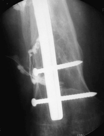 eFIGURE 65–1, Sinogram. A 73-year-old woman presented with discharging sinus about 3 years after internal fixation of a femoral shaft fracture. Sinogram demonstrates the catheter extending into the femur with contrast medium seen at multiple sites along the bone. This demonstrates communication between the bone and a soft tissue abscess as well as multiple cloacae.