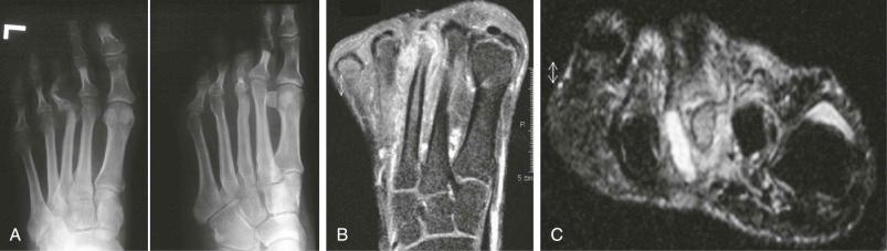 eFIGURE 65–2, Chronic osteomyelitis. A , Plain radiograph shows erosion in the metatarsal head of the third toe. Bony remodeling with thickening of the cortex of the metatarsal shaft is noted. B , Axial T1-weighted, fat-suppressed MR sequence with gadolinium chelate demonstrates erosion of the metatarsal head of the third toe with marrow edema and soft tissue enhancement that is likely to represent extension of infection into the soft tissue. C , T2-weighted MR sequence with fat suppression clearly demonstrates the soft tissue abscess adjacent to the infected third metatarsal.