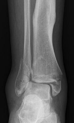 Fig. 45.1, Anteroposterior ankle demonstrating complete fractures with cortical disruption and displacement affecting both the distal fibula and medial malleolus.