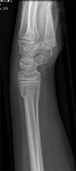 Fig. 45.11, Buckle Fracture.