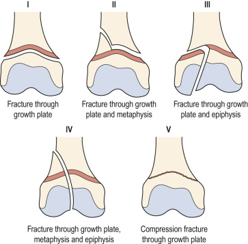 Fig. 45.12, Salter–Harris Classification of Fractures in Children Involving the Growth Plate.