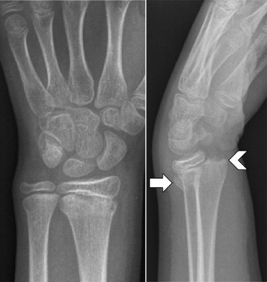 Fig. 45.14, Salter-Harris (S-H) Type 2 Fracture.