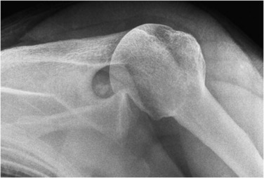 Fig. 45.15, Posterior Dislocation of the Humerus.