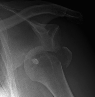 Fig. 45.17, Adolescent Shoulder Anteroposterior View.