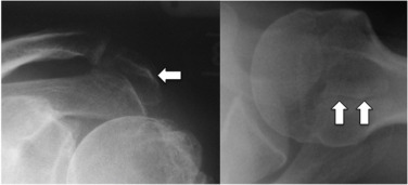 Fig. 45.18, Os Acromiale.