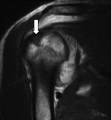 Fig. 45.20, Hill-Sachs Lesion.