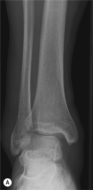 Fig. 45.2, (A and B) Anteroposterior (AP) and lateral views of the ankle. A well-defined oblique ankle fracture on the lateral view cannot be visualised on the AP view.