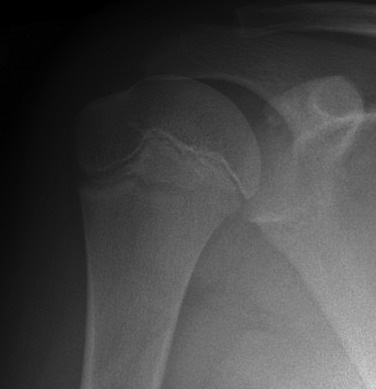 Fig. 45.22, Humeral Head Avulsion.