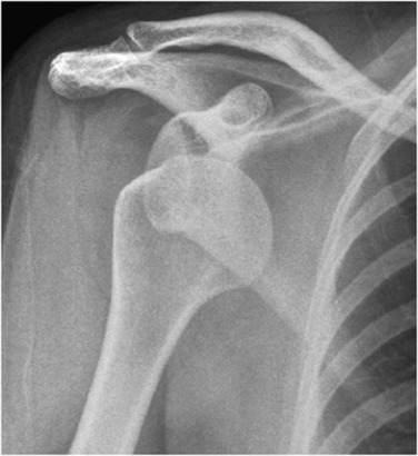 Fig. 45.19, Anterior Dislocation.