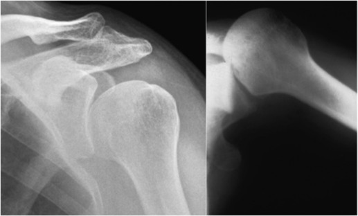 Fig. 45.23, Posterior Dislocation.