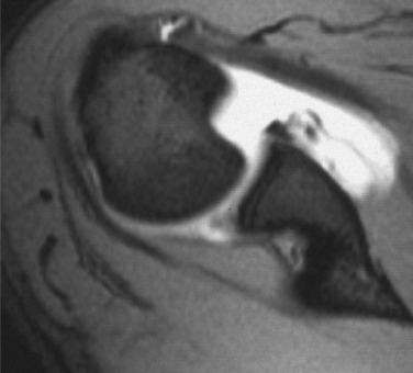 Fig. 45.24, Reversed Hill-Sachs Lesion.