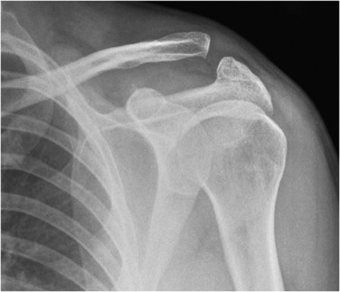 Fig. 45.25, Acromio-Clavicular Joint Subluxation (Grade 2).