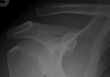 Fig. 45.26, Acromioclavicular Joint Subluxation (Grade 3).