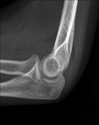 Fig. 45.27, Displaced Fat Pads Are Visible Both Anterior and Posterior to the Humerus.