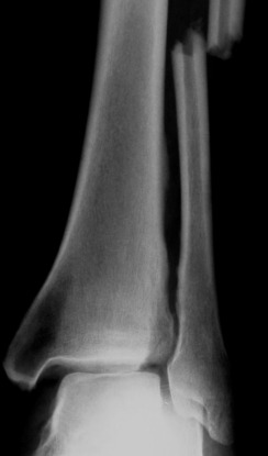 Fig. 45.3, Anteroposterior view of the distal tibia and fibula demonstrating an off-ended fracture of the fibula. Widened medial joint space indicates associated deltoid ligament rupture.