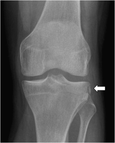 Fig. 45.4, Anteroposterior view of the knee demonstrating an avulsion fracture of the lateral tibial plateau, which represents a Segond injury (arrow) . Anterior cruciate ligament injury highly likely (>95% certainty).