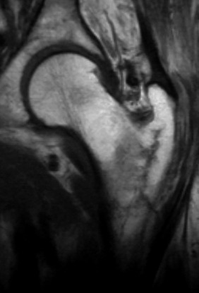 Fig. 45.6, Coronal T 1 Spin Echo MR Image of the Left Hip Demonstrating Incomplete Fracture Line.