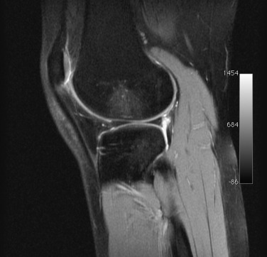 Fig. 45.7, Sagittal short tau inversion recovery image demonstrating geographic (focal) bone bruising of the lateral femoral condyle, which has a high association with anterior cruciate ligament tears.