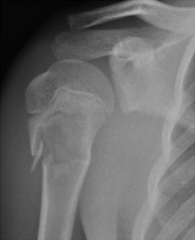 Fig. 45.8, Anteroposterior view in a skeletally immature patient, demonstrating a well-defined metaphyseal lesion, a simple bone cyst (SBC), with an associated pathological fracture.