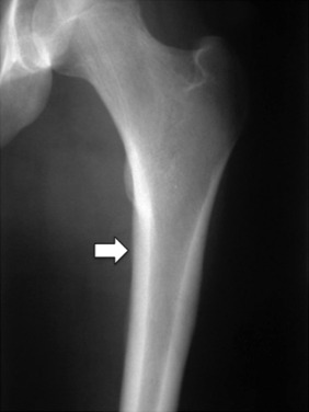 Fig. 45.9, Anteroposterior femur demonstrating a periosteal reaction in a young soldier complaining of 4 weeks pain in the left thigh (arrow) .