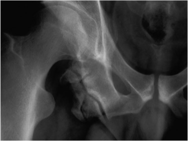 Fig. 45.10, Mature Ischial Apophyseal Avulsion.