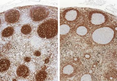 FIG. 31.2, Lymph node showing reactive follicular hyperplasia. Serial sections show strong CD20 immunoreactivity within follicles (left), whereas staining for bcl2 is negative in the follicles (right).