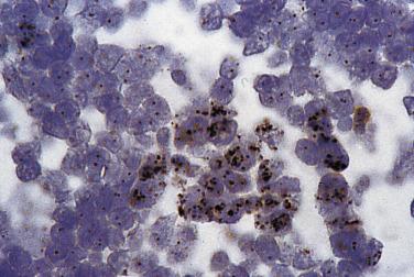 FIG. 31.4, Chromogenic in situ hybridization of an ERBB2 (her2/neu) probe (Zymed Laboratories, South San Francisco, CA) in a breast cancer paraffin section. Probe detection is by peroxidase/DAB. Individual brown dots correspond to the ERBB2 locus, and the carcinoma shows a heterogeneous pattern of amplification. Some cells have ERBB2 amplification (clusters of brown dots) whereas others are nonamplified (one or two single brown dots).