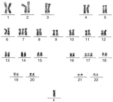 FIG. 31.6, Giemsa-banded karyotype of a papillary renal cell carcinoma showing trisomies for chromosomes 7 and 17 and loss of a sex chromosome.