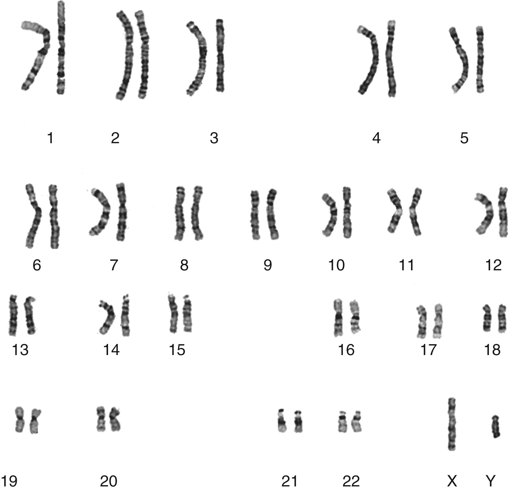 Fig. 71.1, Karyogram of male human chromosome complement, with 46 total chromosomes ordered in pairs. Note the nonhomologous pair of sex chromosomes with one X and one Y chromosome (lower right) .