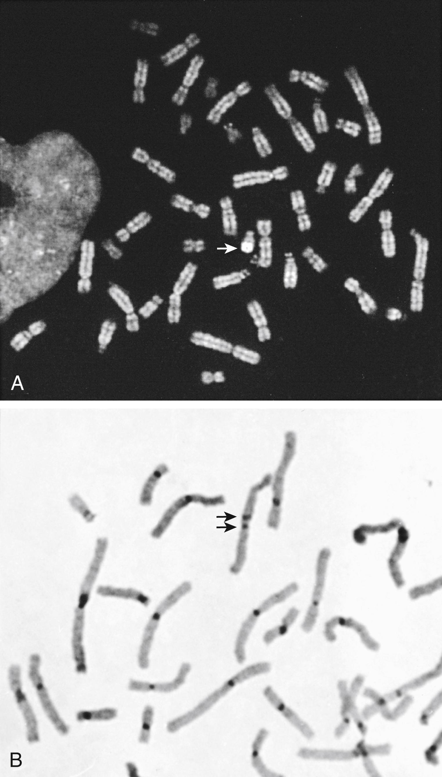 Fig. 71.5, A Q-banded metaphase showing bright fluorescence of the Y chromosome (arrow) . B C-banded chromosomes showing the dark staining centromeres. A dicentric chromosome was detected with two dark bands (arrows).