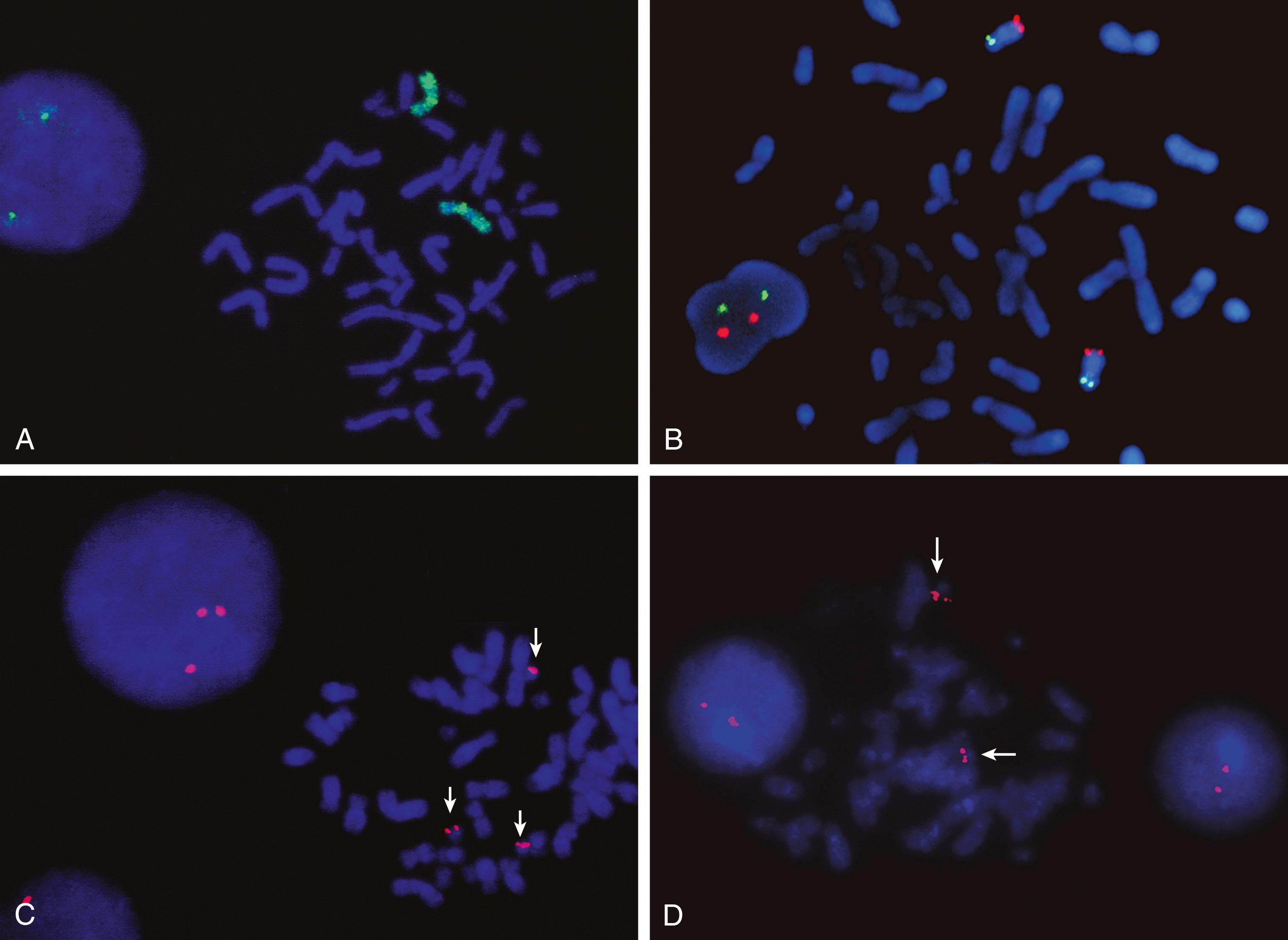 Fig. 71.6, Fluorescence in situ hybridization. A Whole chromosome paint probe highlighting the two X chromosomes in a female cell. B Chromosomes showing hybridization with subtelomere probes. The p arm subtelomere is indicated by the green signals, and the q arm subtelomere is indicated by the red signals. Paired red and green signals are seen in the interphase nucleus to the left . C and D Repeat sequence centromere probe for chromosome 21. C Trisomy 21 seen at left in an interphase nucleus and at right in a metaphase (arrows). D Normal complement of two copies of chromosome 21 (arrows) seen in interphase ( left and right ) and in a metaphase (center).