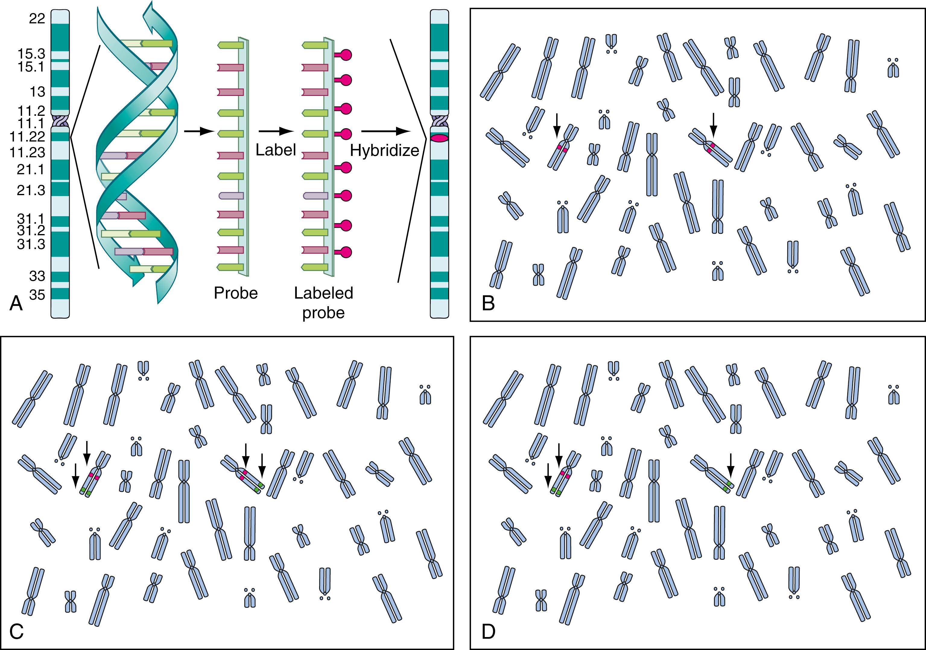 Fig. 71.7, A Schematic of fluorescence in situ hybridization (FISH) technology. DNA derived from a known gene is rendered single stranded, labeled with a fluorescent tag, and then hybridized back to the chromosomes of a metaphase cell. B to D Depiction of a metaphase cell with 46 chromosomes that has been processed using FISH technology. The labeled probes hybridized to targets are indicated with arrows . B Dual signals indicating hybridization to both alleles of target gene. C Target gene indicated by red signal and a control probe indicated in green . Complete hybridization to all alleles. D Hybridization of both controls (green) but presence of only a single target gene, indicating deletion of one allele.