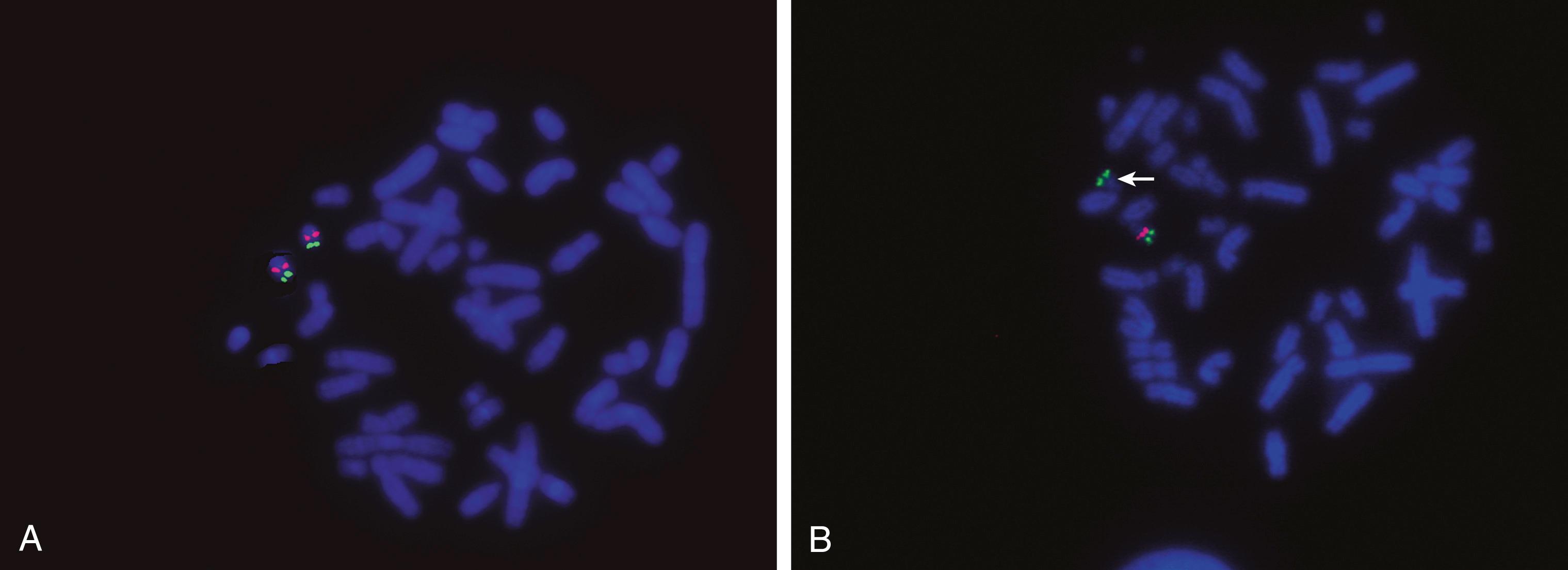 Fig. 71.8, Fluorescence in situ hybridization detection of a microdeletion of chromosome 22 associated with velocardiofacial syndrome. A An individual with no deletion showing the presence of one red (gene locus) and one green (control locus) signal for each chromosome 22. B Patient with a deletion seen as a chromosome with only a single green (control) signal. The homologous chromosome 22 is “normal” with one red and one green signal.