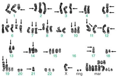 Figure 18.1, Complex Karyotype.