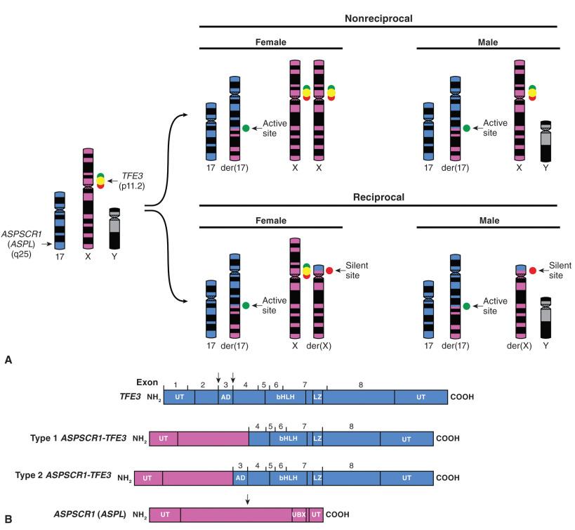 Figure 18.12, Cytogenetics of Alveolar Soft Part Sarcoma.