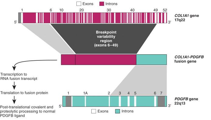 Figure 18.15, Dermatofibrosarcoma Protuberans Fusion Gene.