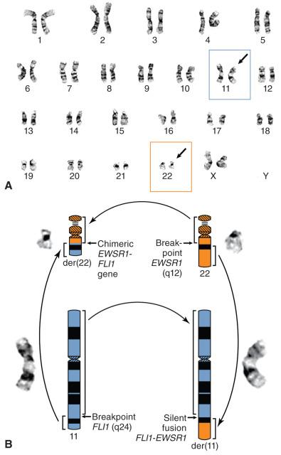 Figure 18.2, Karyotype and Ideogram of Ewing Sarcoma.