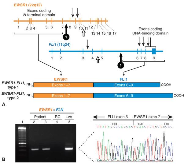 Figure 18.3, Gene Fusion and Reverse Transcription Polymerase Chain Reaction (RT-PCR) Detection in Ewing Sarcoma.