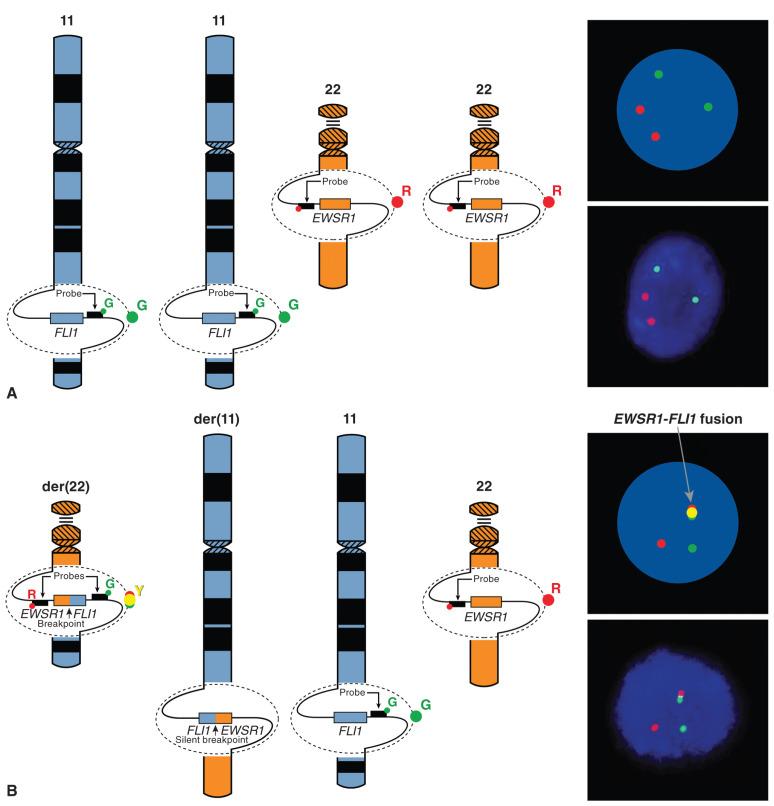 Figure 18.7, Fusion Fluorescence In Situ Hybridization (FISH) for the EWSR1 Locus.