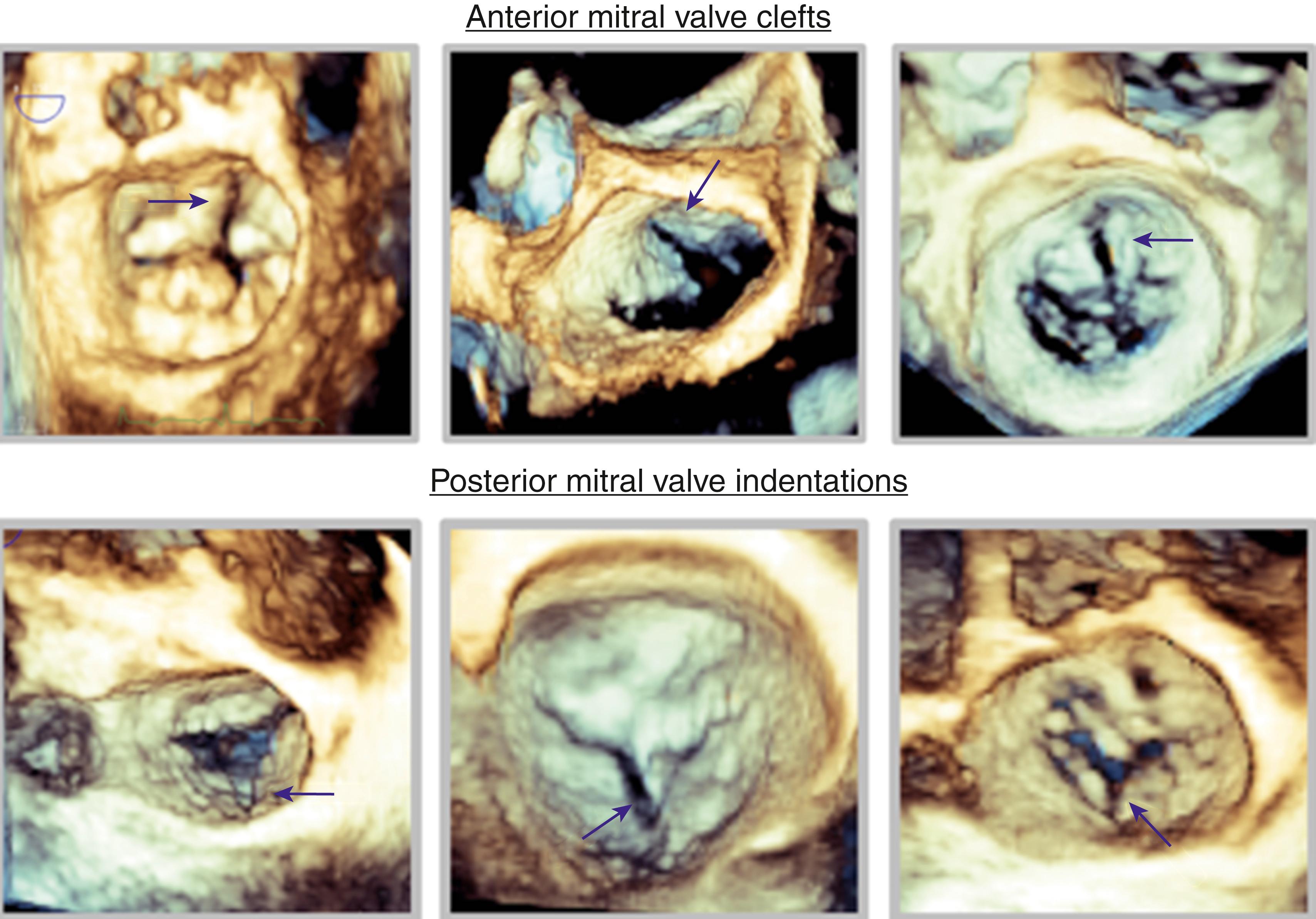Figure 14.1, Representative cases of anterior cleft morphologies (top row) and posterior mitral cleft indentations (bottom row) as visualized by three-dimensional imaging of the mitral valve en face using surgeon’s view.