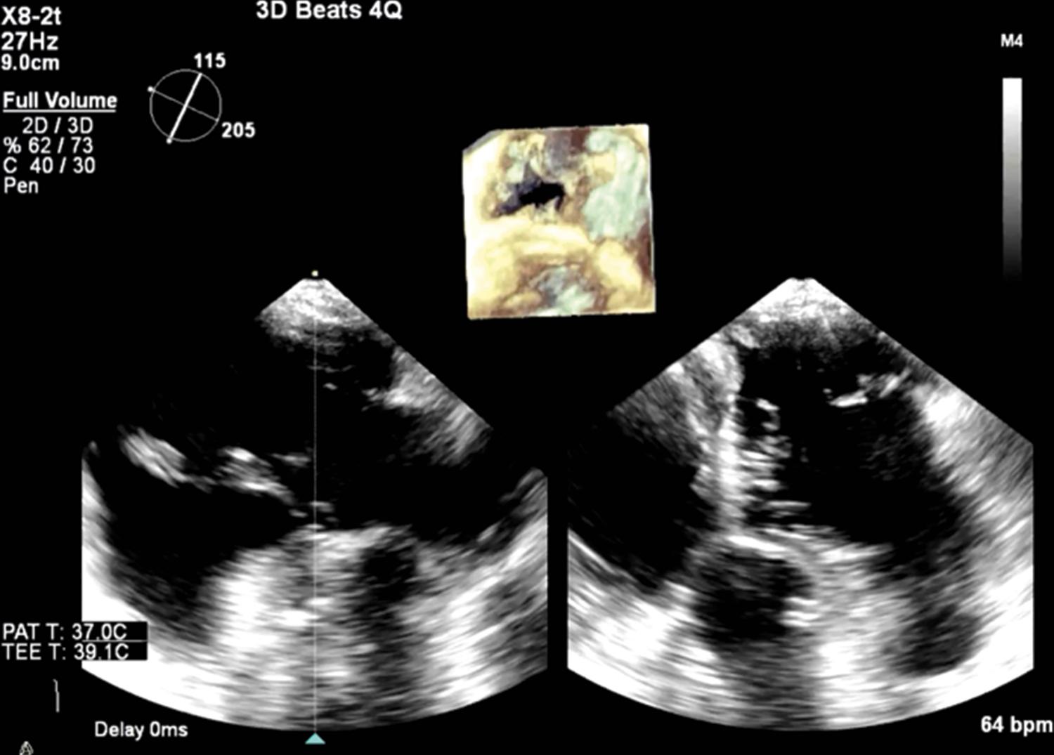 Figure 14.4, Representative three-dimensional acquisition of tricuspid valve from transgastric view. See accompanying Video 14.4 .