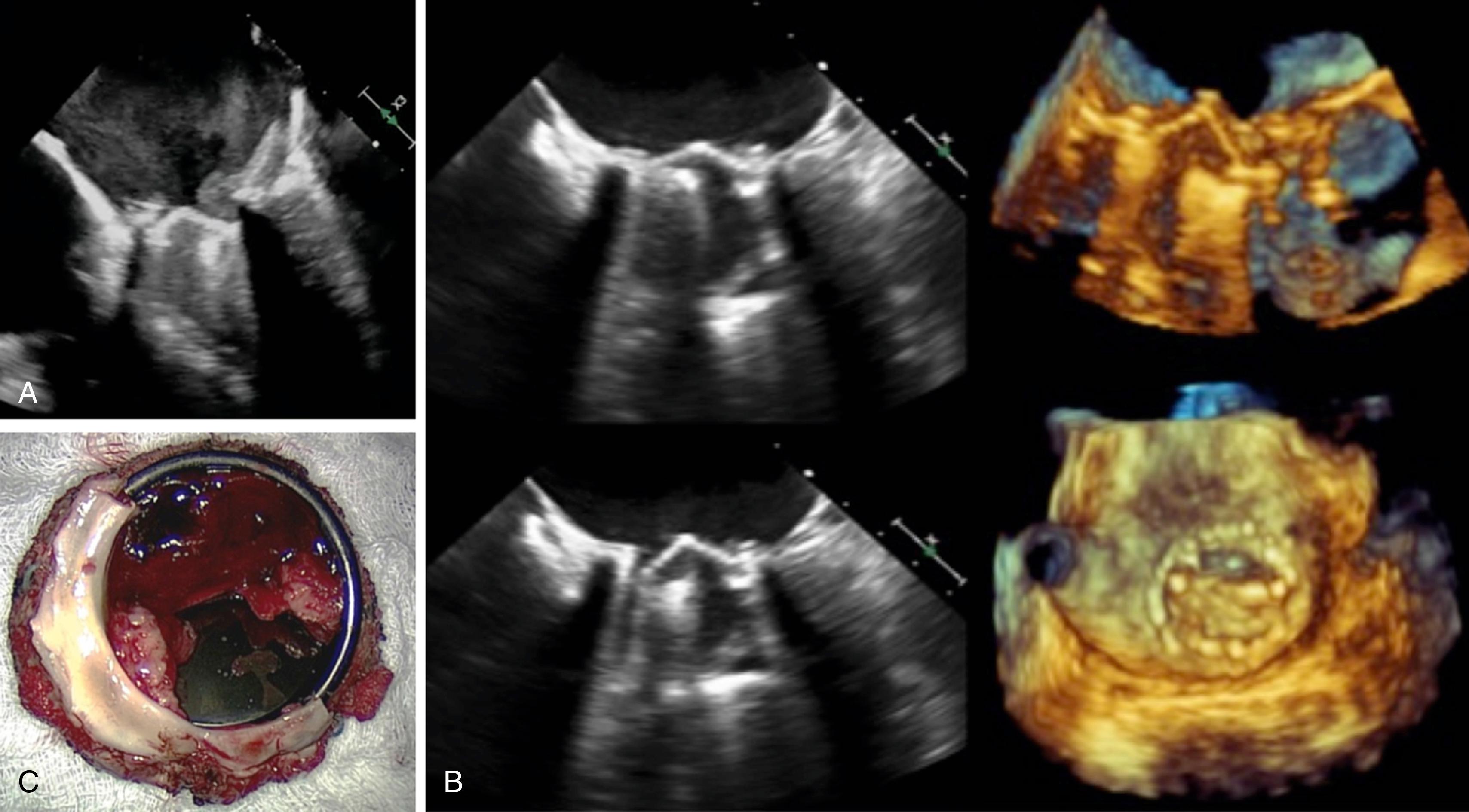 Figure 14.5, A, Mechanical mitral prosthesis thrombosis with left atrial and valve-associated thrombus and dense spontaneous echo contrast in the left atrium. B, Mechanical mitral prosthesis dysfunction with immobile posterior mechanical leaflet on two- and three-dimensional imaging with pathology demonstrating amalgam of acute and chronic thrombus, with pannus formation ( C ). See accompanying Video 14.5A , Video 14.5B .