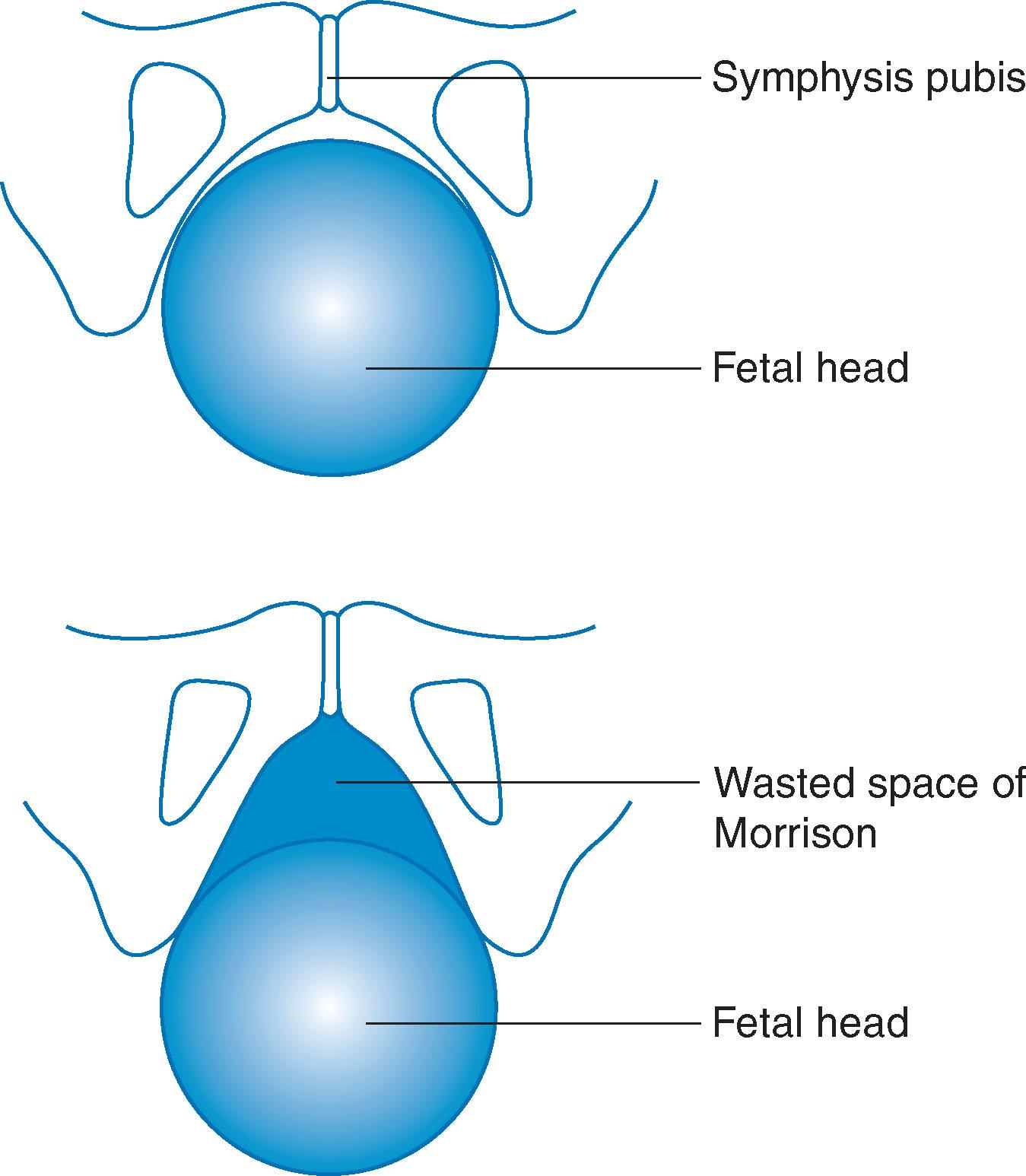 Fig. 5.9, Illustration of the effect of a narrow subpubic arch and the waste space of Morrison.