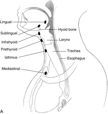 Fig. 2.3, A, Schema illustrating some common sites for midline ectopic thyroid masses. B, A summary of the major medial and lateral embryologic elements of the thyroid gland and their potential adult anatomic consequences. C, Thyroid rests grades I through IV. D, Three grades of tubercle of Zuckerkandl (TZ) development. Note also the potential of injury for a ventrally placed recurrent laryngeal nerve (RLN) with a posteriorly situated tubercle. E, Thyrothymic rest grade I arising from inferior aspect of thyroid. F , Thyrothymic rest grade III attached with fibrovascular core. G , RLN passing anterior to TZ.