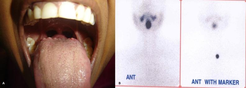 Fig. 2.4, A, An enlarged lingual thyroid located at the base of the tongue. B, Radioiodine scan with an increased uptake focus at the base of the tongue with no apparent activity in the normal pretracheal location of the thyroid gland in the neck.