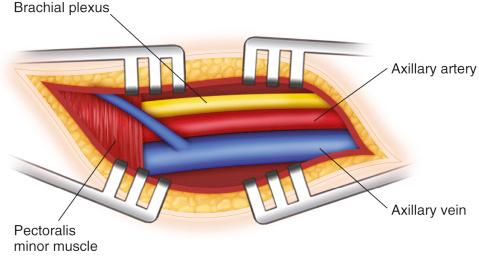 Figure 31.3, Axillary artery anatomy.