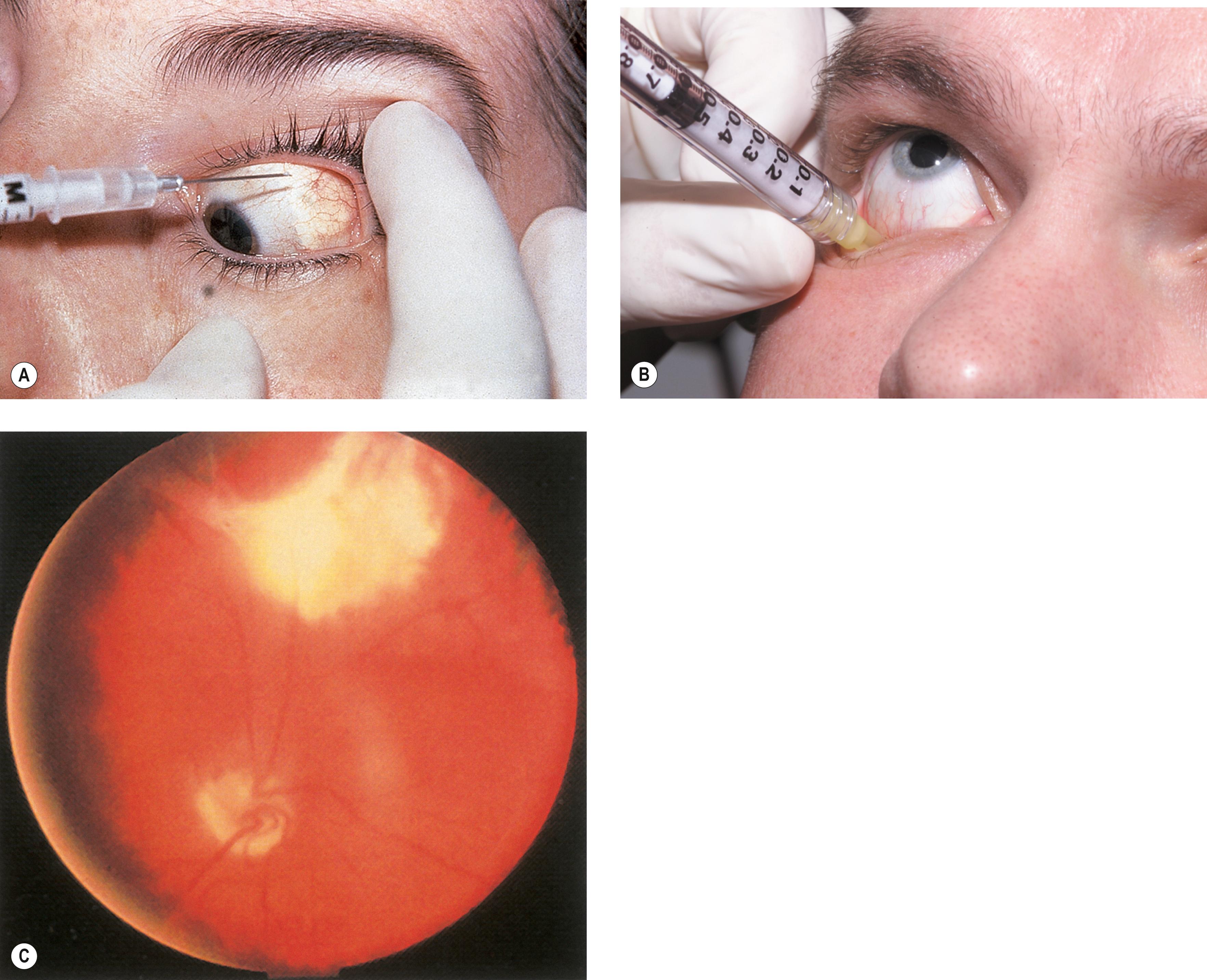 Fig. 8.3, (A) Temporal approach to giving periocular injection. (B) Inferior fornix approach. (Courtesy Dr. Roxana Ursea.) (C) Although the possibility is markedly reduced if precautions are taken, perforation of the globe can occur, as seen here.