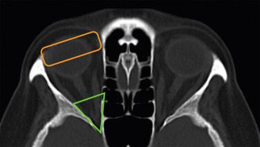 Figure 36.1, Axial high-resolution CT scan with bony windows and thin cuts to the orbit. The shape of the orbit is compared to a four-sided pyramid in which the apex is situated posteriorly (green triangle) and the base anteriorly (orange rectangle).